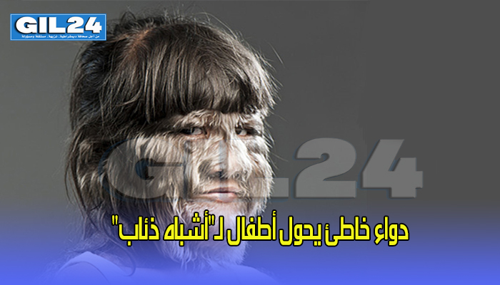 دواء خاطئ يحول أطفال لـ”أشباه ذئاب”缩略图 دواء خاطئ يحول أطفال لـ”أشباه ذئاب”缩略图