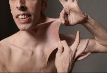 متلازمة إهلرز–دانلوس :مرض نادر يؤثرعلى النسيج الضام缩略图