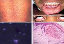 مرض فابري : مرض نادر يمكن خلطه مع أمراض شائعة缩略图 مرض فابري : مرض نادر يمكن خلطه مع أمراض شائعة缩略图