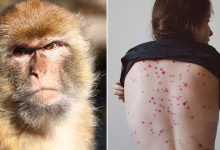 جدري القردة: منظمة الصحة العالمية تعلن حالة طوارئ صحية عالمية وتوقعات بعدم توفر اللقاح قبل أشهر缩略图