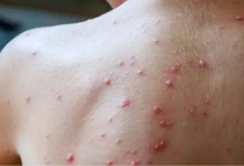 وزارة الصحة تُعلن تسجيل حالة إصابة مؤكدة بجدري القردة缩略图