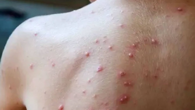 وزارة الصحة تُعلن تسجيل حالة إصابة مؤكدة بجدري القردة缩略图