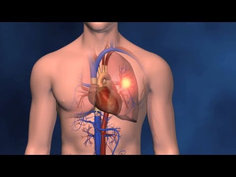 Deep Vein Thrombosis (DVT)