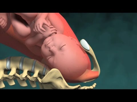 Parto Vaginal Normal