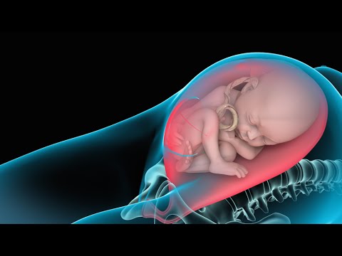 C-section (Cesarean Delivery)